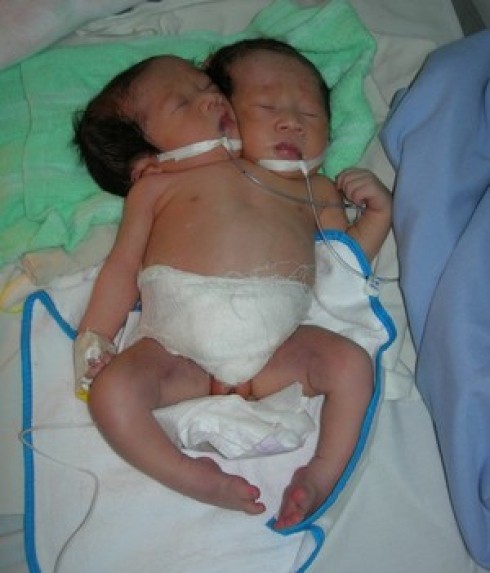 The baby has one body but two heads, two hearts, two spinal columns, two legs and one sex organ in previous year (Photo: VNE)